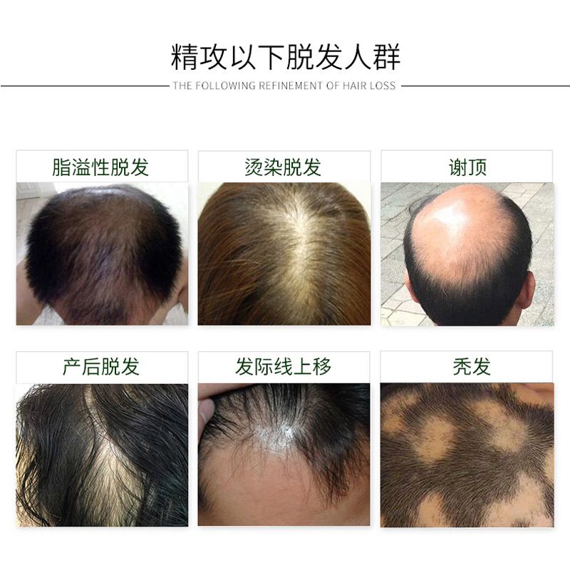 如何快速治疗头皮屑 20180830052346379.jpg