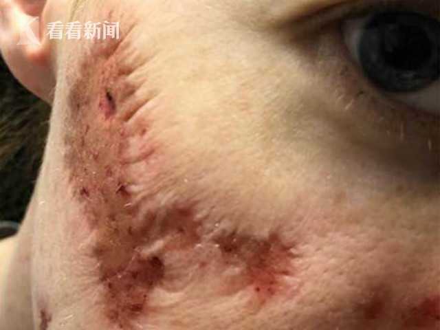 女子公厕用皂液洗手感染 脸部腐烂现坑洞如僵尸