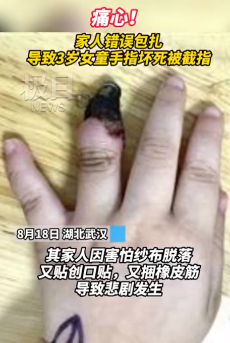 不要乱用创可贴！一名3岁女孩的手指因家人错误包扎而坏死。网友:心疼。插图1