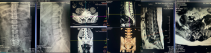 南溪山醫院3D打印技術助力脊柱手術，讓患者重獲新生