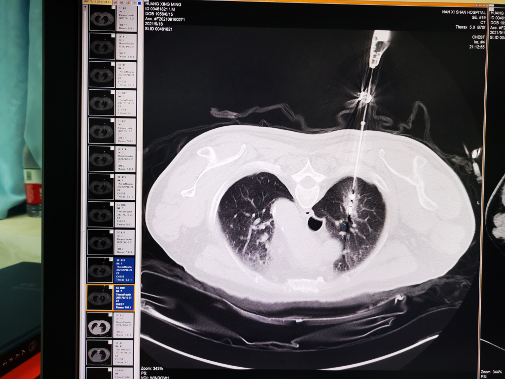 体检发现肺结节，会变成肺癌吗？| 健康总动员_玻璃_密度_混合