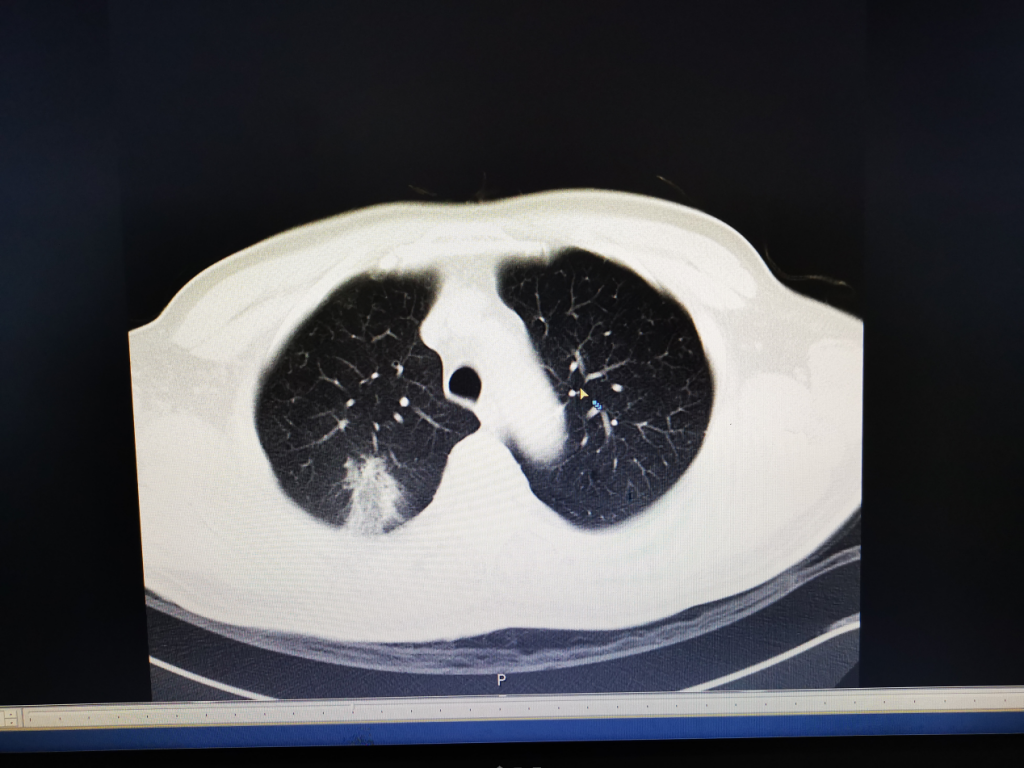 罗江区人民医院成功开展首例CT引导下肺结节术前穿刺定位术_四川在线